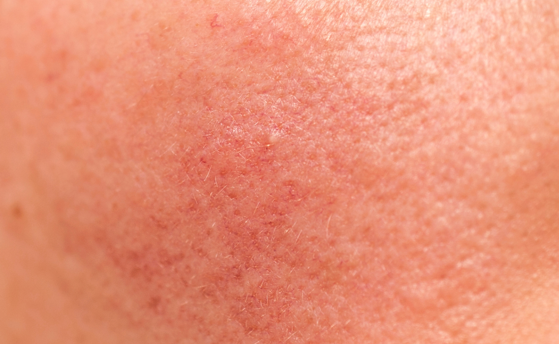 How to Repair a Damaged Skin Barrier