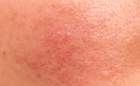 How to Repair a Damaged Skin Barrier