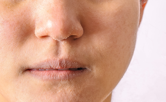 Dry Skin or Damaged Skin Barrier? How to Tell the Difference